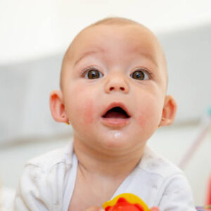 Πρόσωπο / Σώμα / Ατοπική Δερματίτιδα