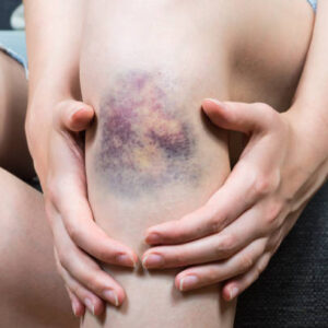 Μώλωπες - Οίδημα