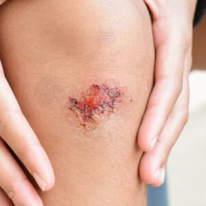 Περιποίηση Τραύματος